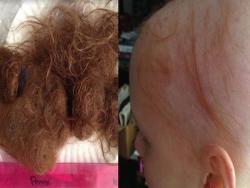 女童大量掉髮以為罹患癌症，沒想到始作俑者竟是人們每天會用的「它」！