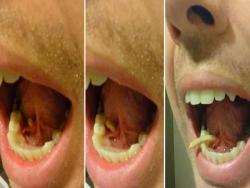 美男總覺得舌下腫脹，沒想到舌頭用力一推竟擠出近4公分的唾腺結石！