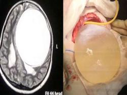 少女長期頭痛甚至造成右半身癱瘓，直到最近X光一照下後驚見大型囊腫！