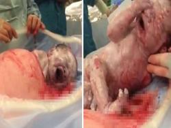 剖腹產到一半，血淋淋的寶寶居然「伸手自己爬出子宮」！